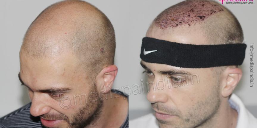 hair transplant before after asutralia