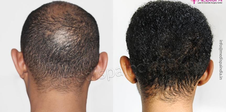hair transplant before after south african