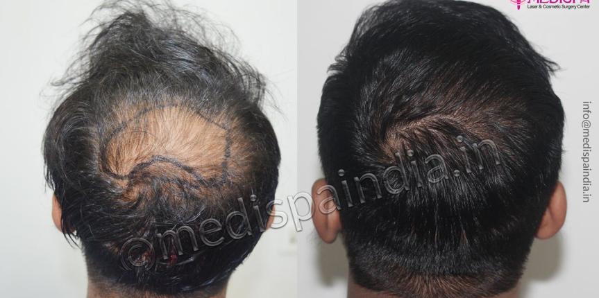 bad hair transplant replair delhi