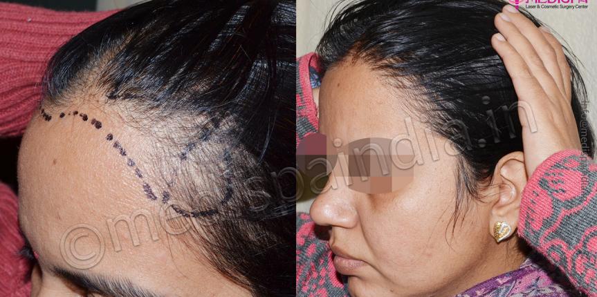 female hair transplant results jaipur