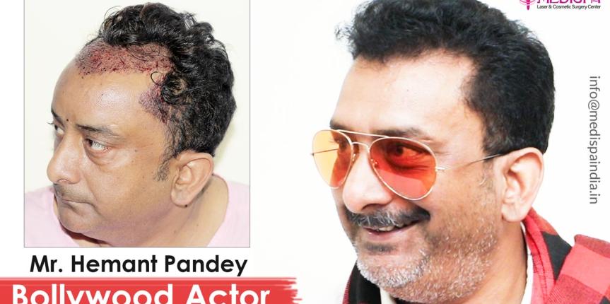 celebrity hair transplant hemant pandey