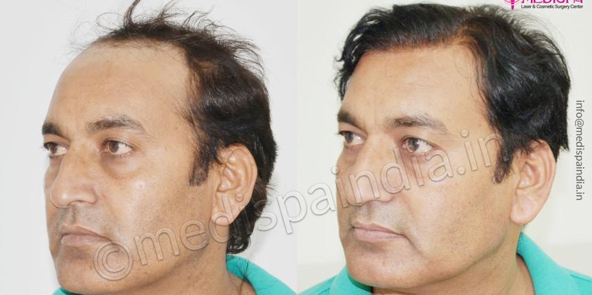 hair transplant surgeons in south delhi