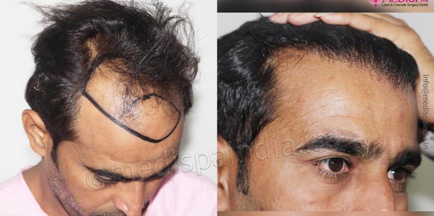 hair transplant results in jaipur india