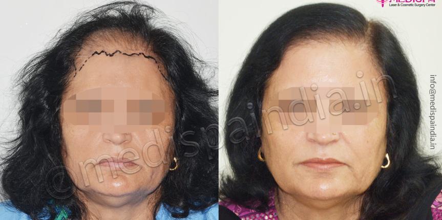 hair transplant surgeons in south delhi new-delhi