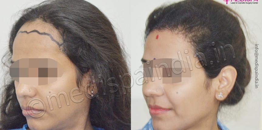 hair restoration cost in jaipur india