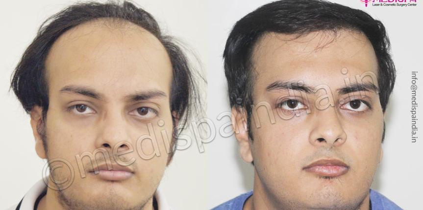 hair transplant in jodhpur