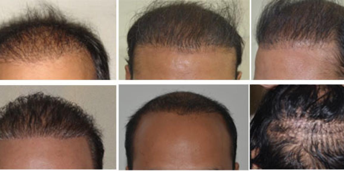 Why Hair Transplant Repair Can Be A Good Idea After A Bad Hair Transplant?