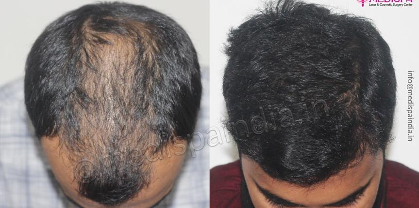 best hair transplant results delhi india