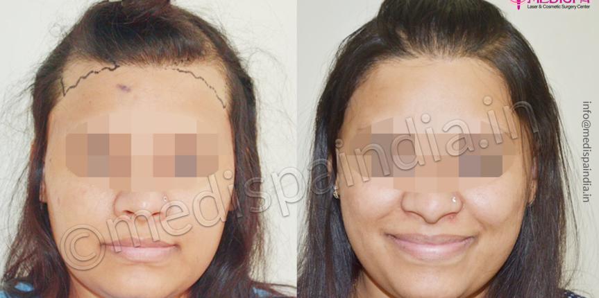 hair transplant cost in chennai india