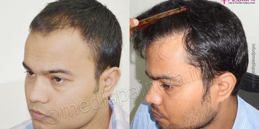 male hair transplant results delhi