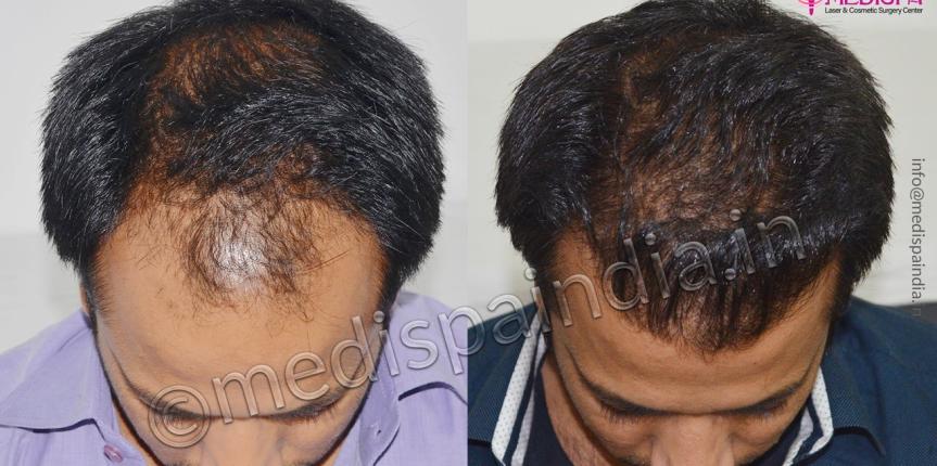 hair transplant clinics in gurugram