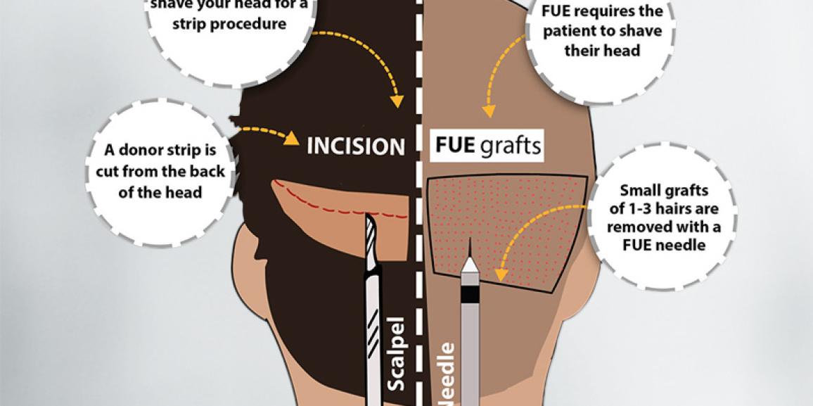 Explain The Difference Between FUT And FUE Hair Transplant