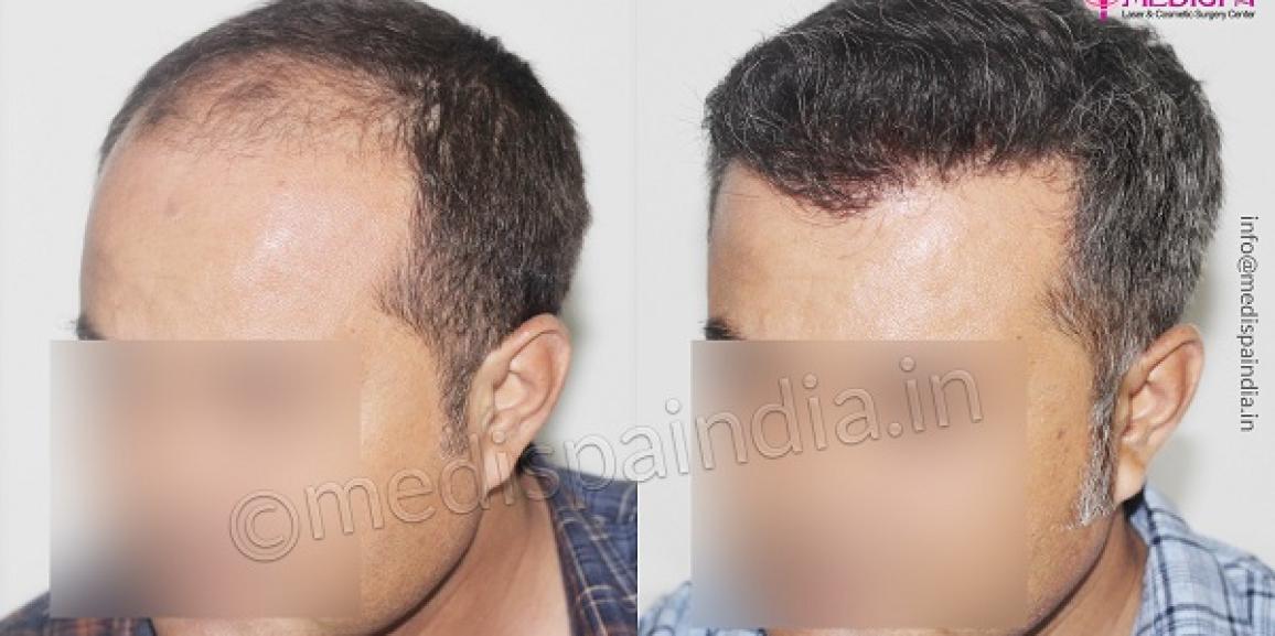 Key Factors To Consider While Choosing Hair Transplant Clinic