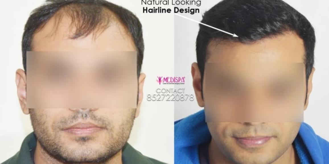 How Much is The Cost of Hair Transplant in Bhiwadi?