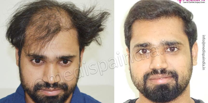 mumbai hair transplant cost