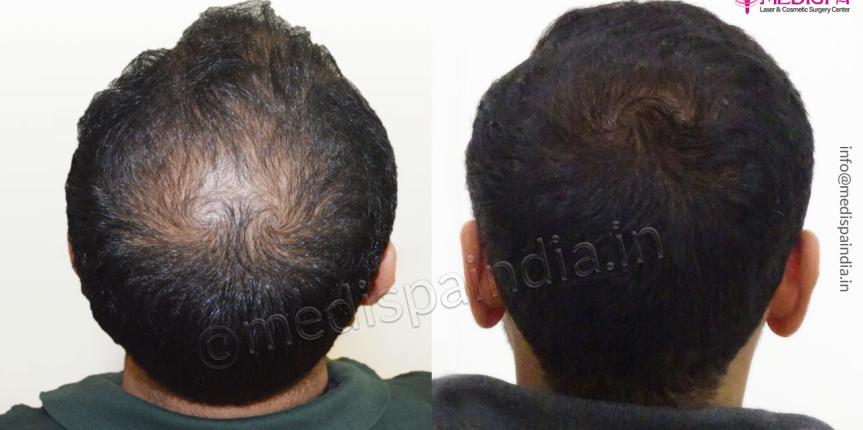 Hair Transplant Jaipur results