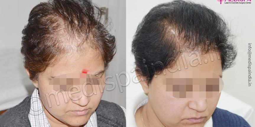 female hair transplant cost jaipur