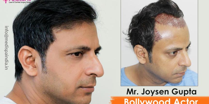 bollywood actor joysen gupta hair transplant jaipur
