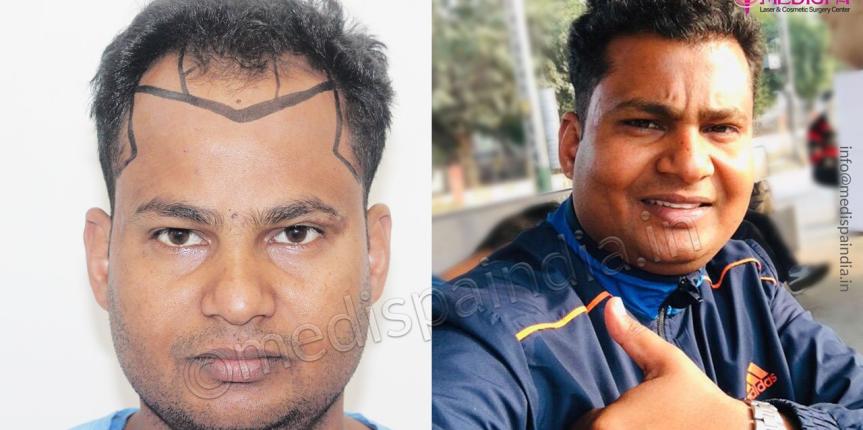 best hair transplant rajathan after
