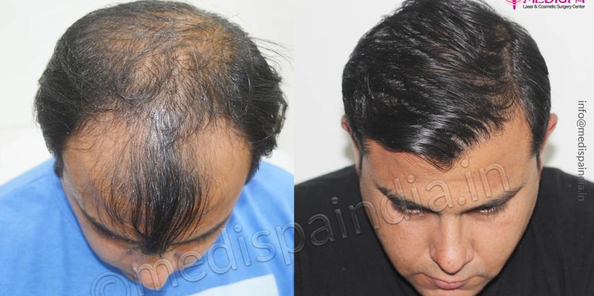 hair transplant clinics in bhubhneshwar
