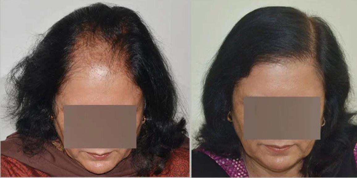 What is The Success Rate of Hair Transplant in Women?