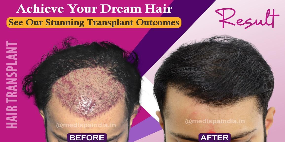 What Are The Precautionary Measures Should Be Followed After Hair Transplant?