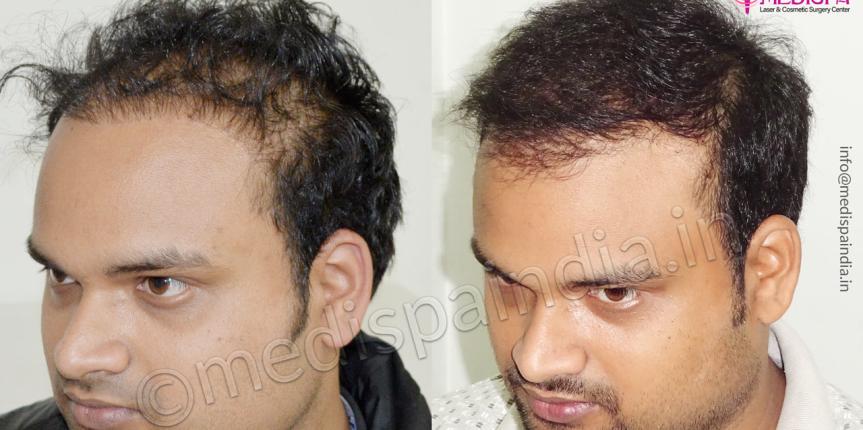 best hair transplant results in india