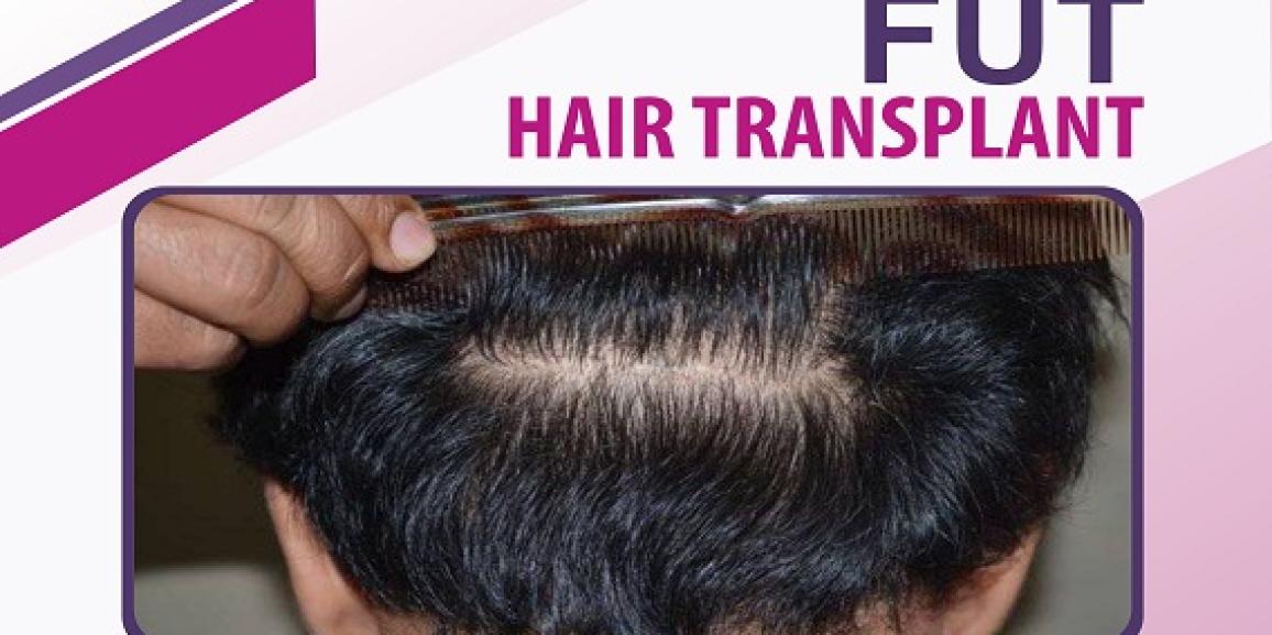 How FUT Hair Transplant Can Help Curing Hair Loss Issue?