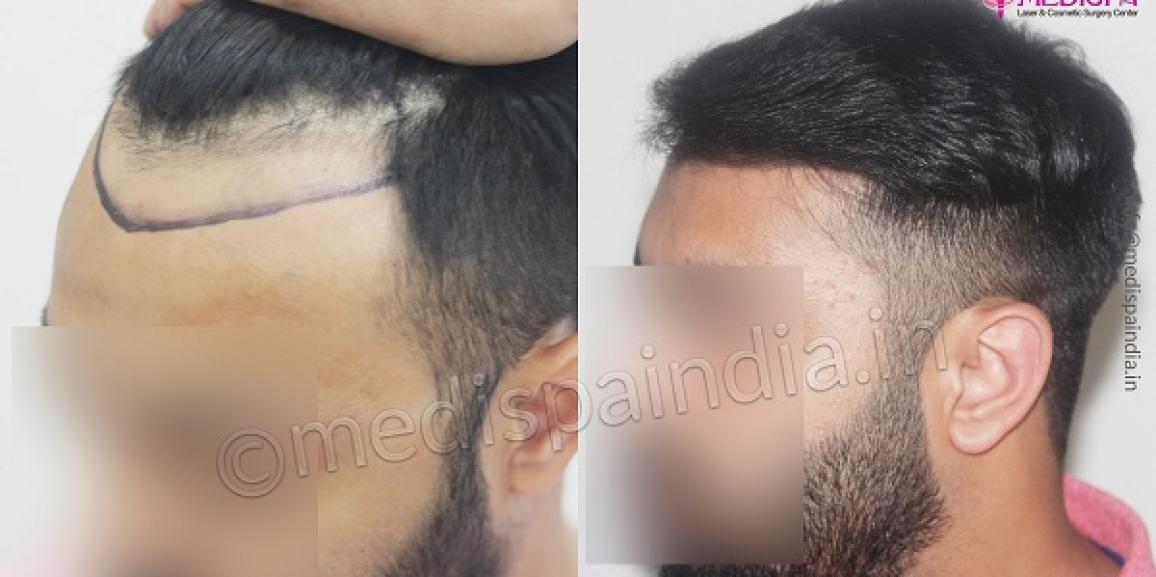 What Are The Primary Reasons For Undergoing Hair Transplant?