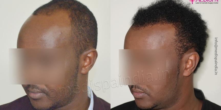 africans hair restoration