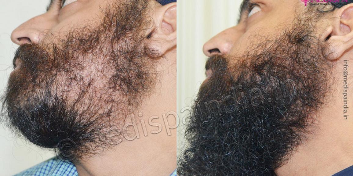 Everything To Need To Know About Beard Hair Transplant