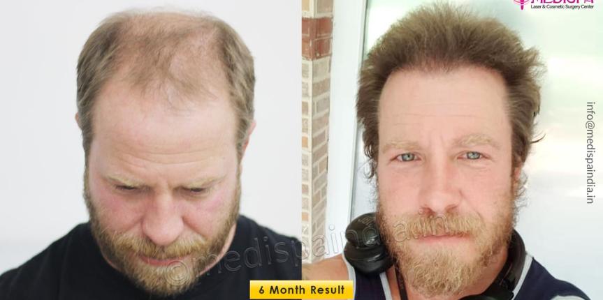 hair restoration usa patient