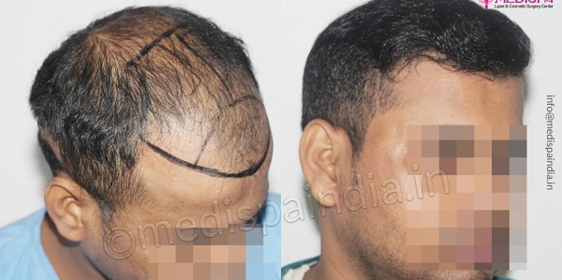 Hair Transplantation: Before, During, And After