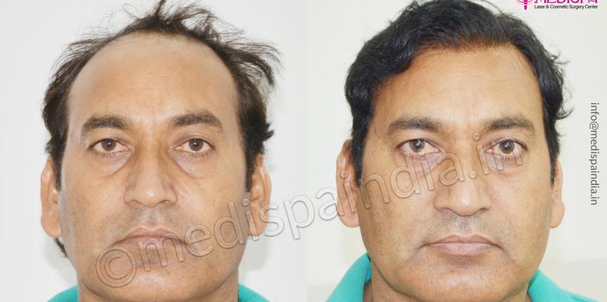 hair transplant doctors in south delhi